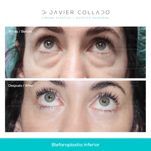 blefaroplastia inferior