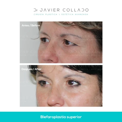 blefaroplastia superior
