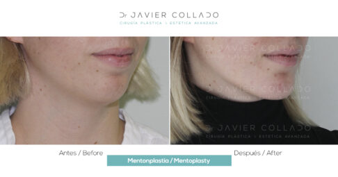 Caso éxito de mentoplastia por el doctor Javier Collado