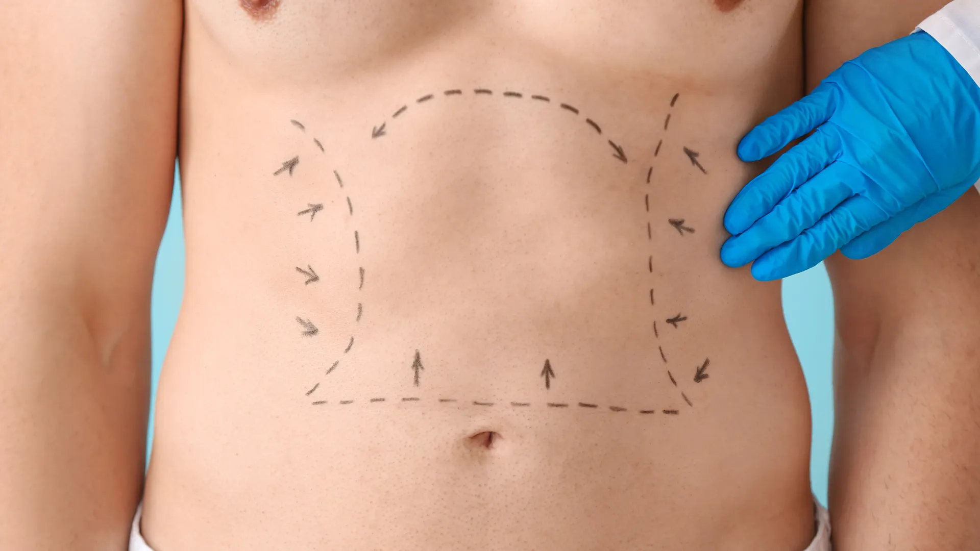 Abdominoplastia para hombre o cirugía del abdomen en Sevilla